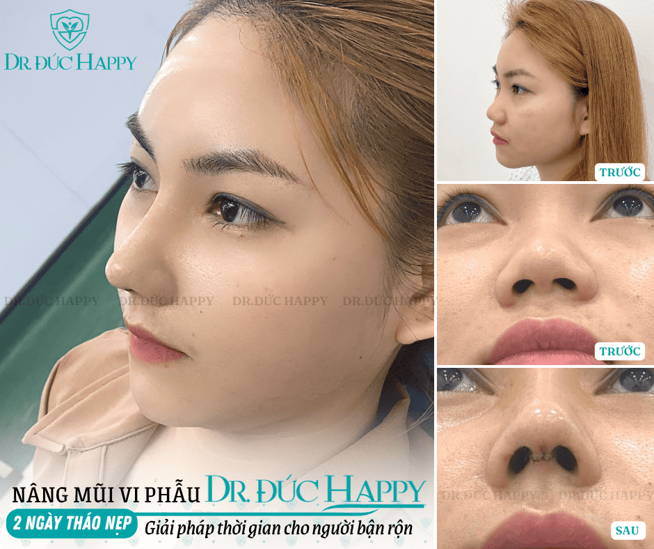 Nâng mũi bao lâu tháo nẹp đã không còn là vấn đề với phương pháp nâng mũi vi phẫu