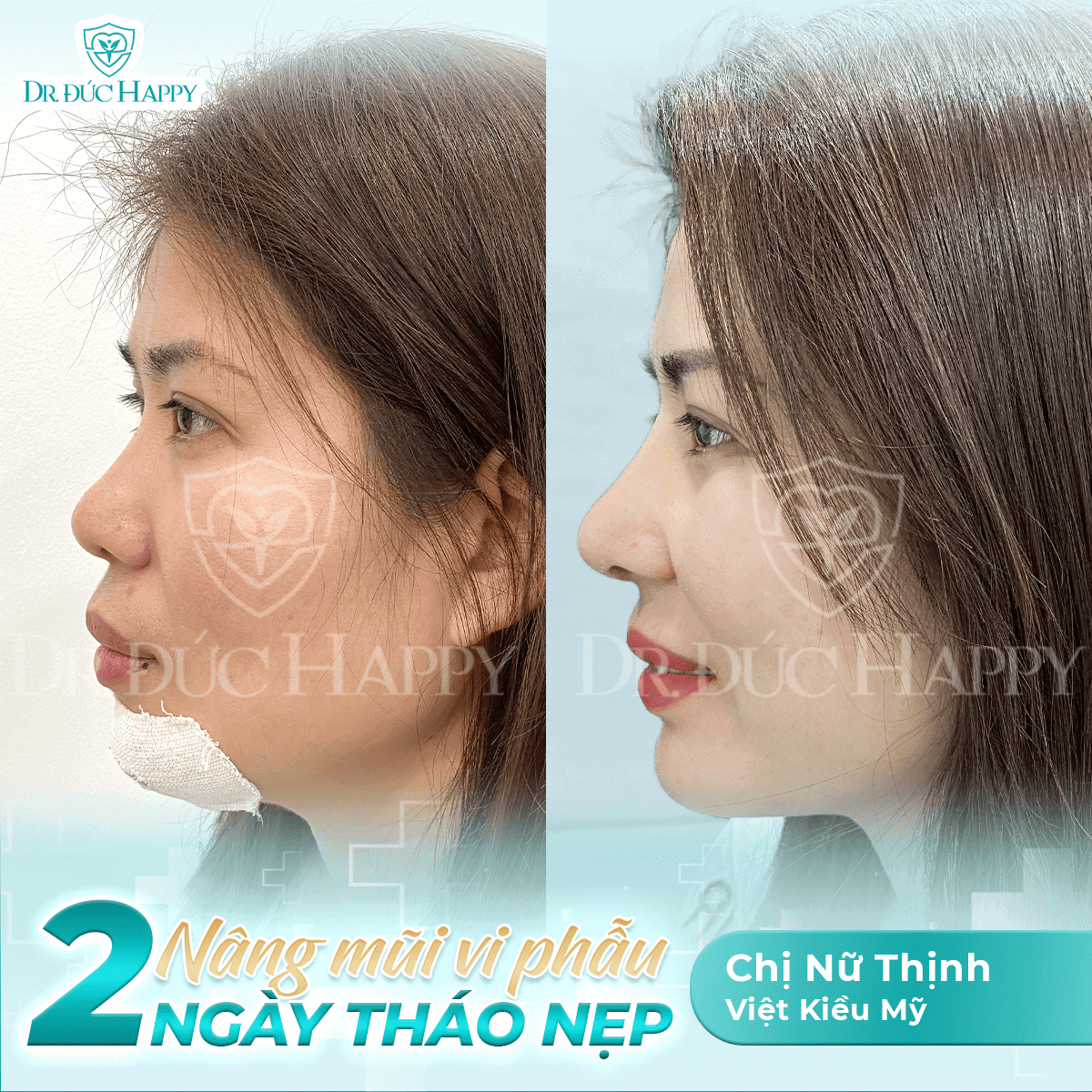 Nâng mũi mấy ngày tháo nẹp