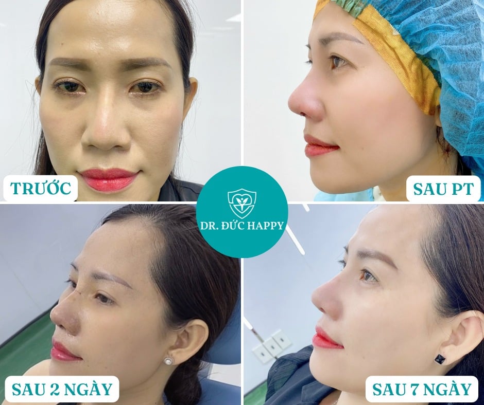 Nâng mũi mấy ngày tháo nẹp