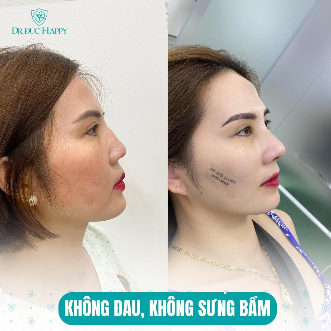 Nâng mũi mấy ngày tháo nẹp