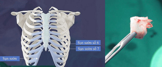 sửa mũi sụn sườn hỏng sửa mũi sụn sườn hỏng