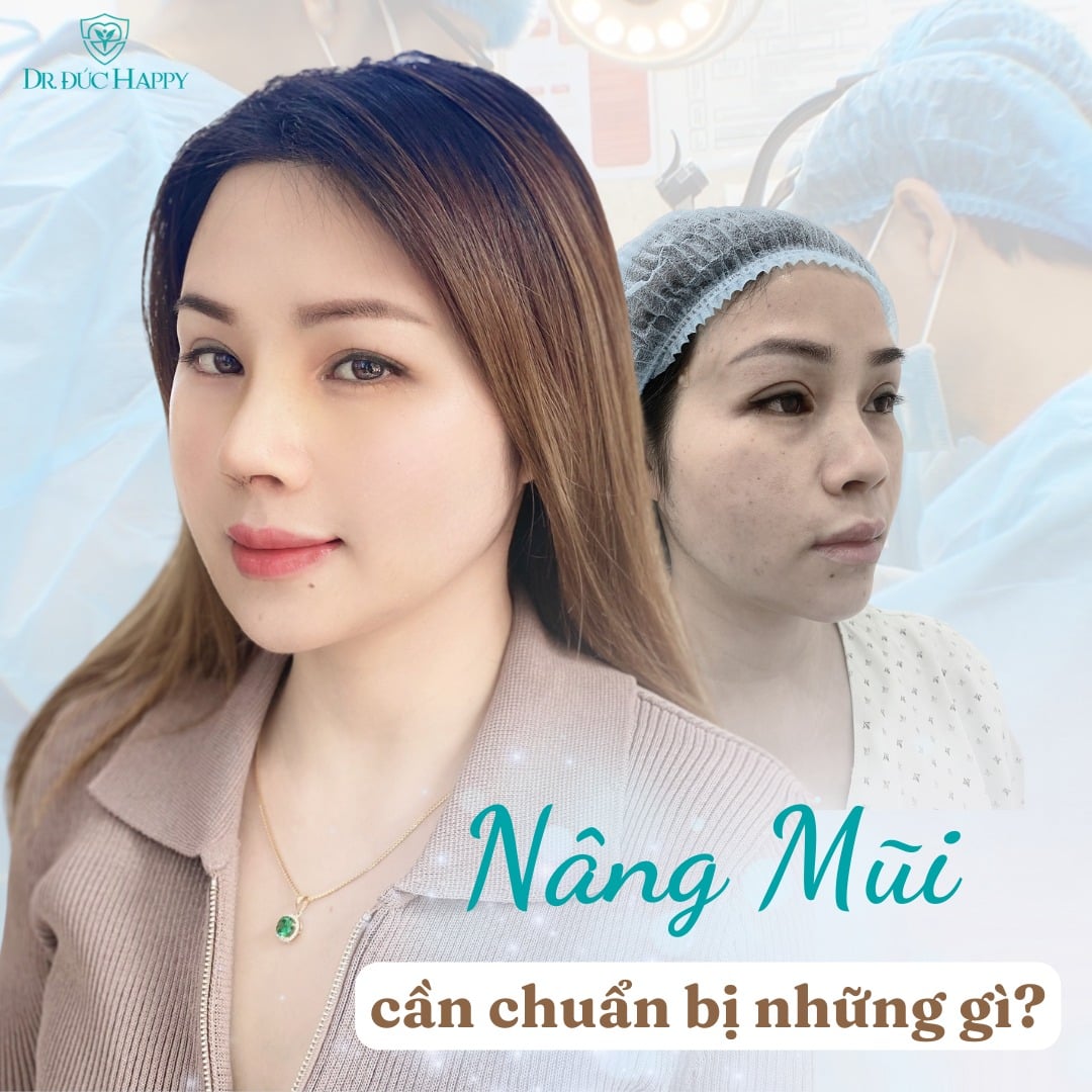 Sửa mũi sụn sườn hỏng Sửa mũi sụn sườn hỏng
