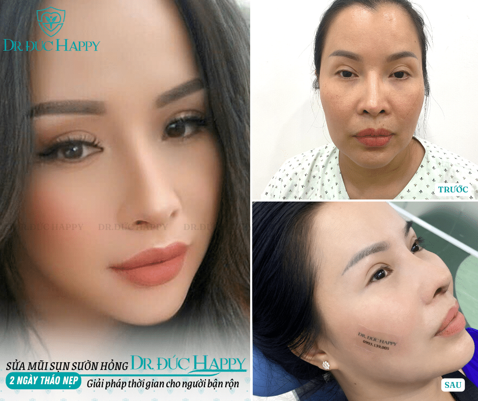 sửa mũi sụn sườn hỏng sửa mũi sụn sườn hỏng