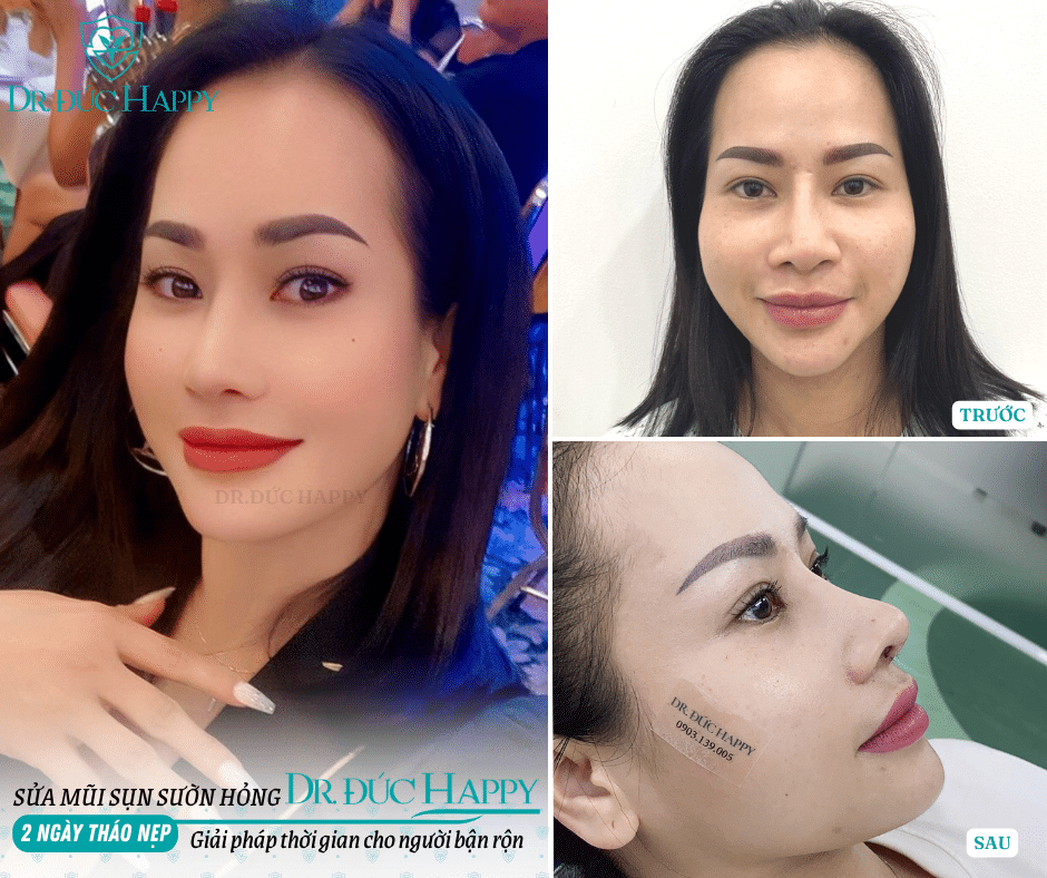 sửa mũi sụn sườn hỏng sửa mũi sụn sườn hỏng