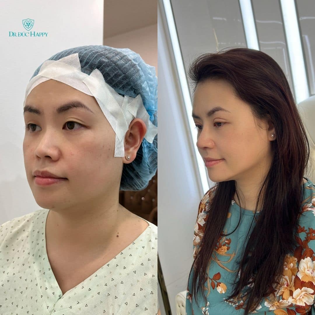 Nâng mũi bao lâu tháo nẹp