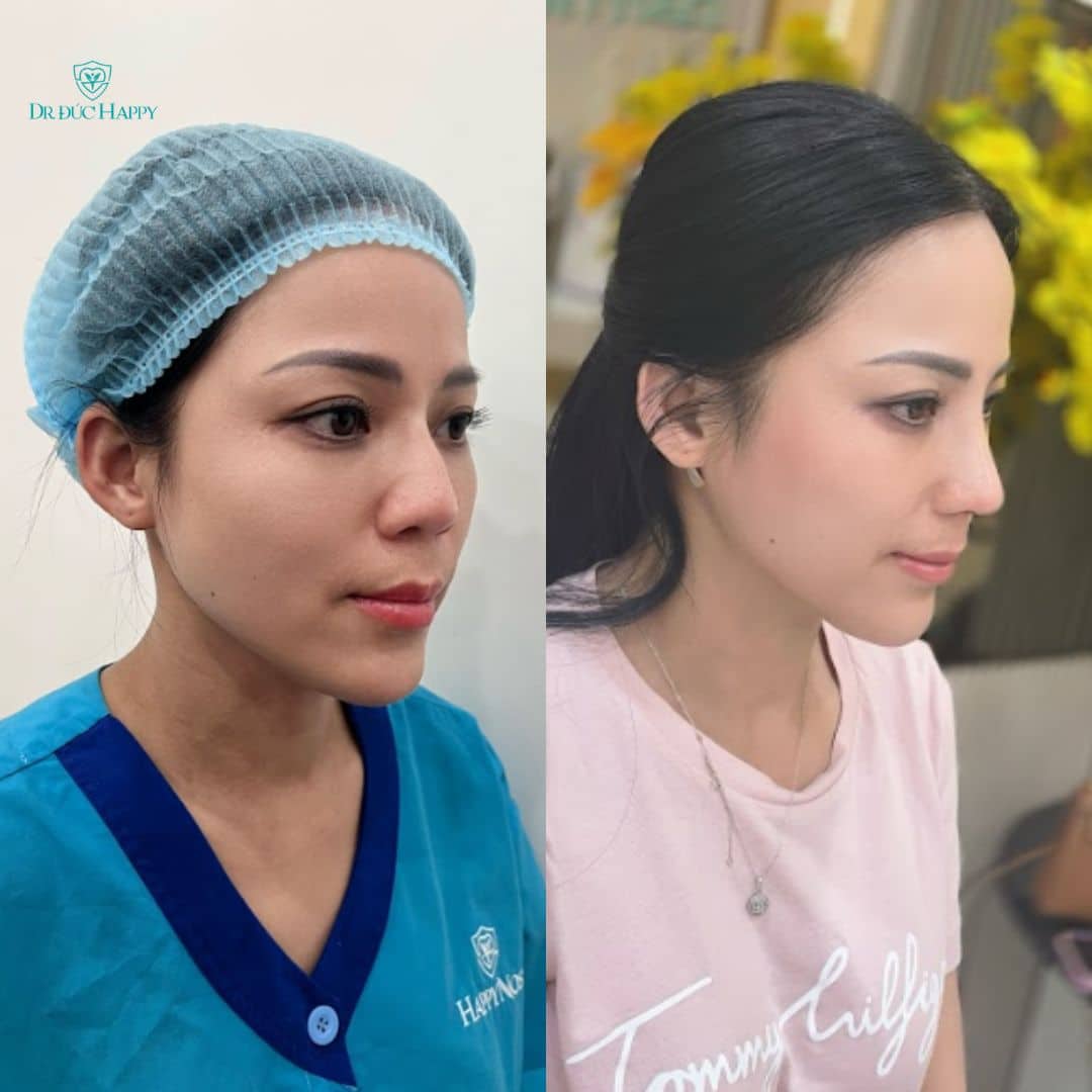 nâng mũi mấy ngày tháo nẹp