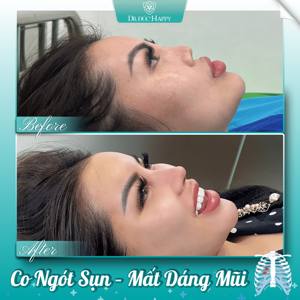Mũi co rút sau nâng sụn sườn