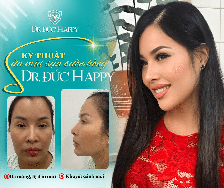 Biến chứng mũi hỏng với da mỏng và đầu mũi bất thường