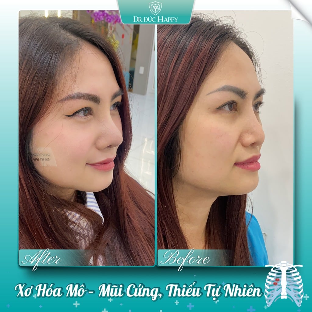 Xơ hóa mô sau nâng mũi làm mũi cứng thiếu tự nhiên
