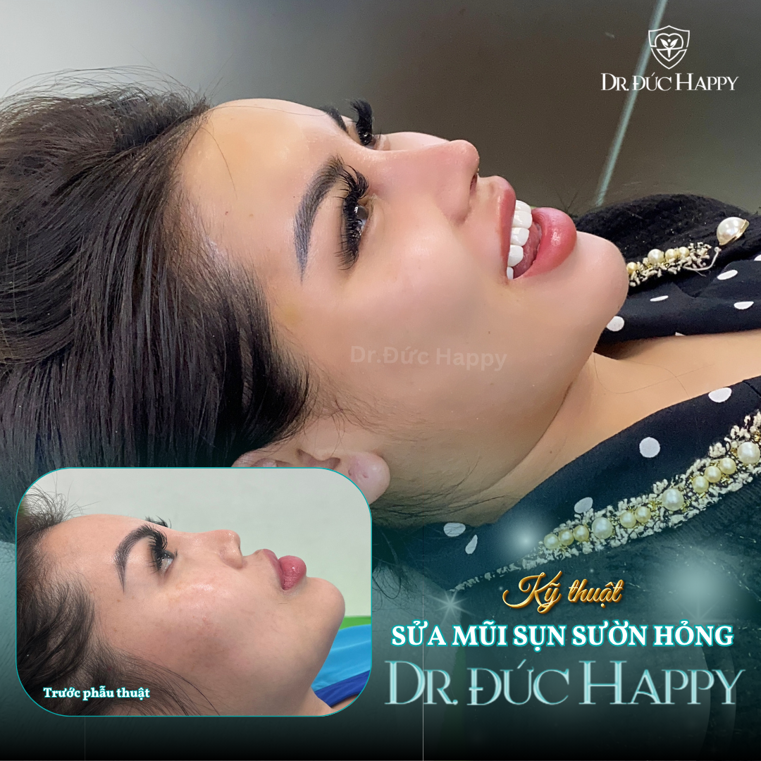 Kết quả sửa mũi sụn sườn hỏng tại Dr. Đức Happy