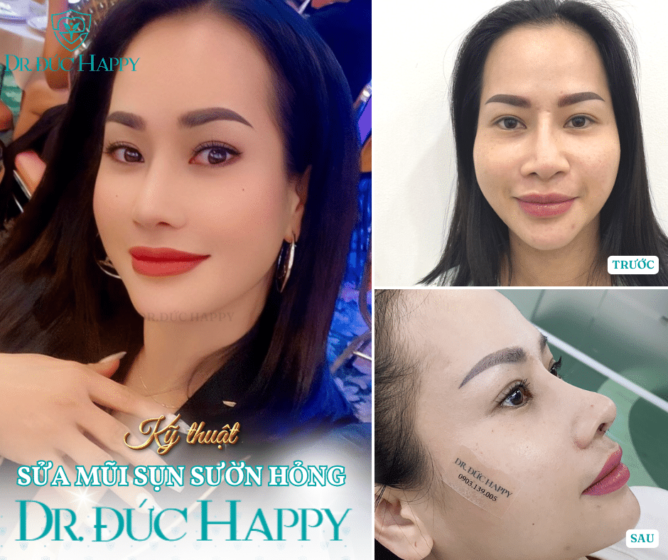 Khách hàng sau sửa mũi sụn sườn hỏng tại Dr. Đức Happy