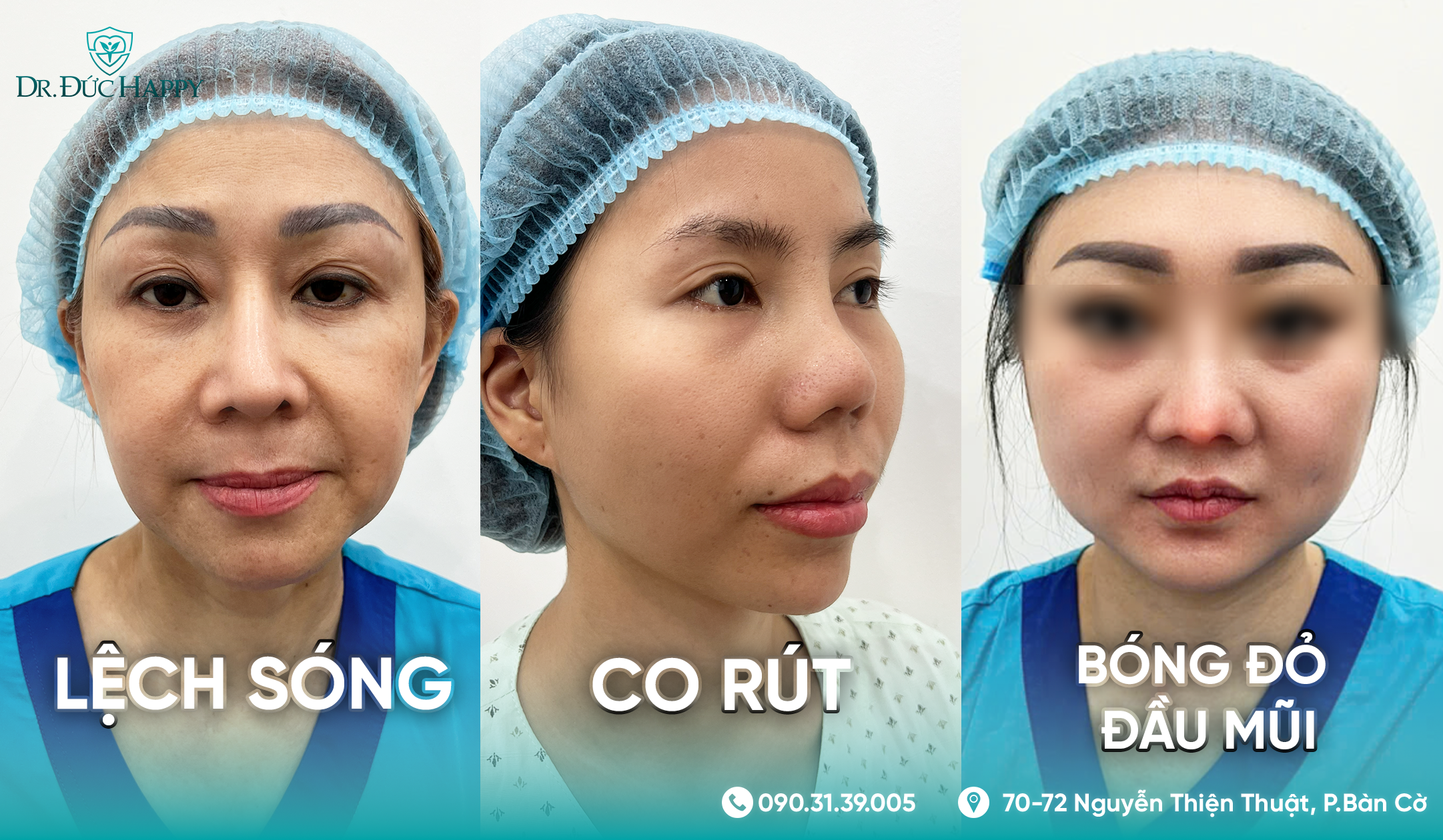 Dấu hiệu sửa mũi sụn sườn hỏng gồm lệch sống co rút bóng đỏ