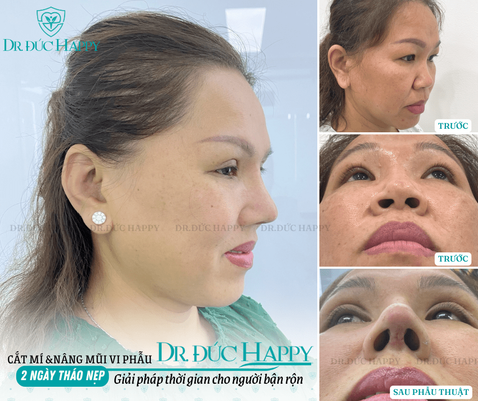 chỉnh sửa mũi hỏng