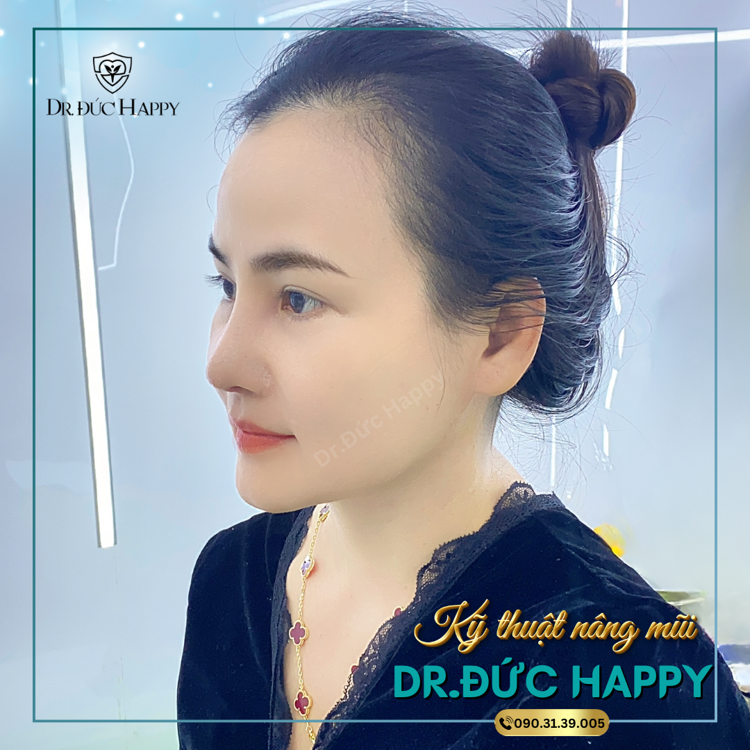 Nâng mũi mấy ngày tháo nẹp