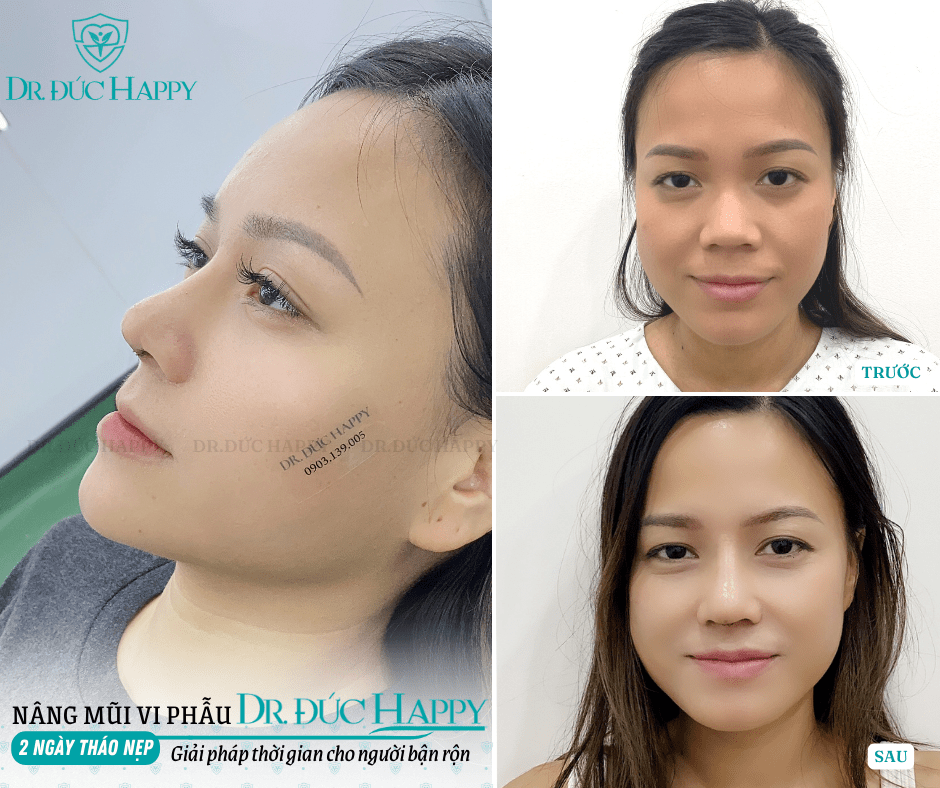 sửa mũi sụn sườn hỏng sửa mũi sụn sườn hỏng