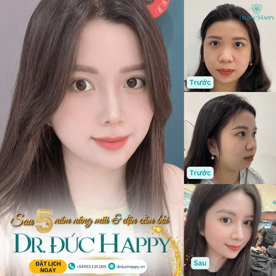 Nâng mũi vi phẫu