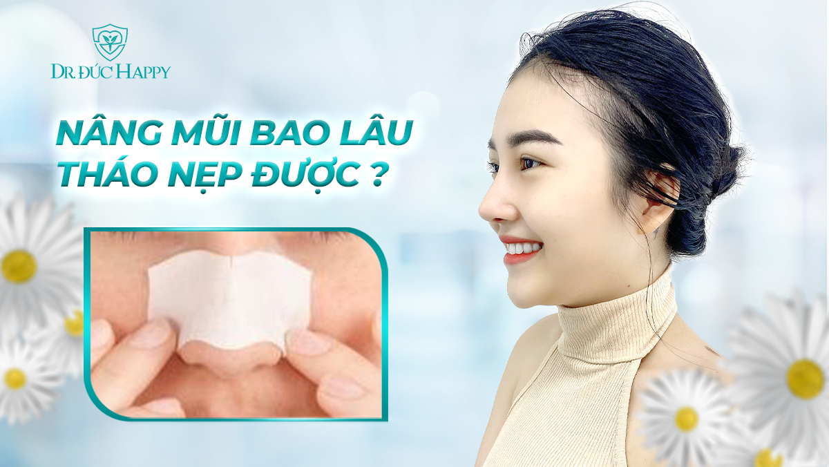 Nâng mũi bao lâu tháo nẹp