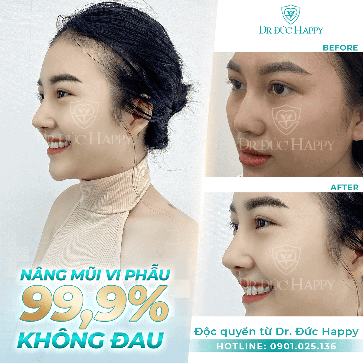 sửa mũi hỏng vi phẩu