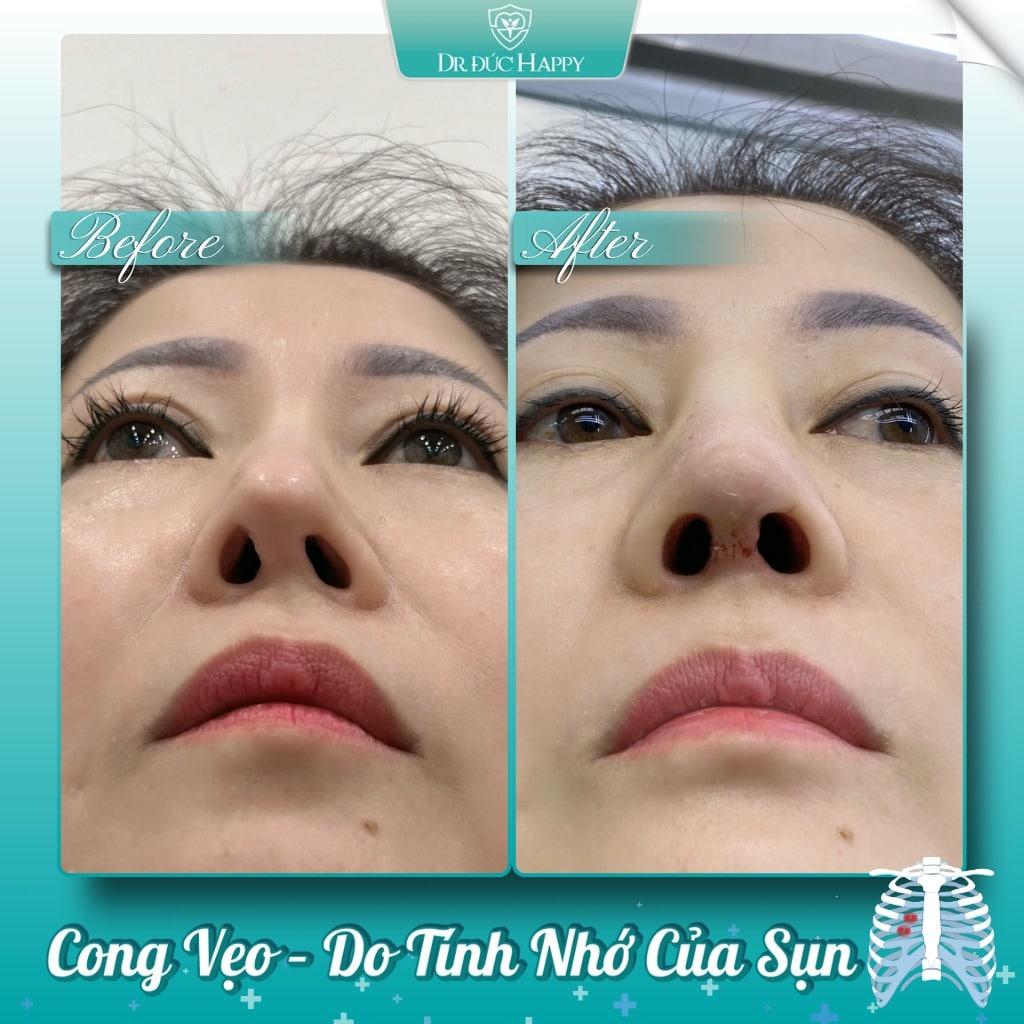 Sửa mũi sụn sườn hỏng Dr. Đức Happy - Hệ luỵ của sụn sườn