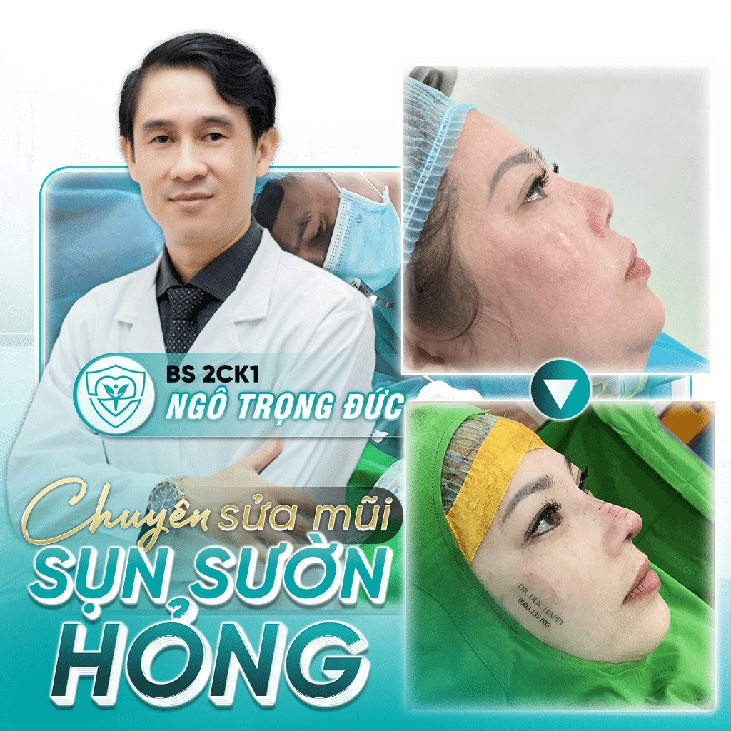 Sửa mũi sụn sườn hỏng Dr. Đức Happy - Sửa mũi hỏng vi phẫu