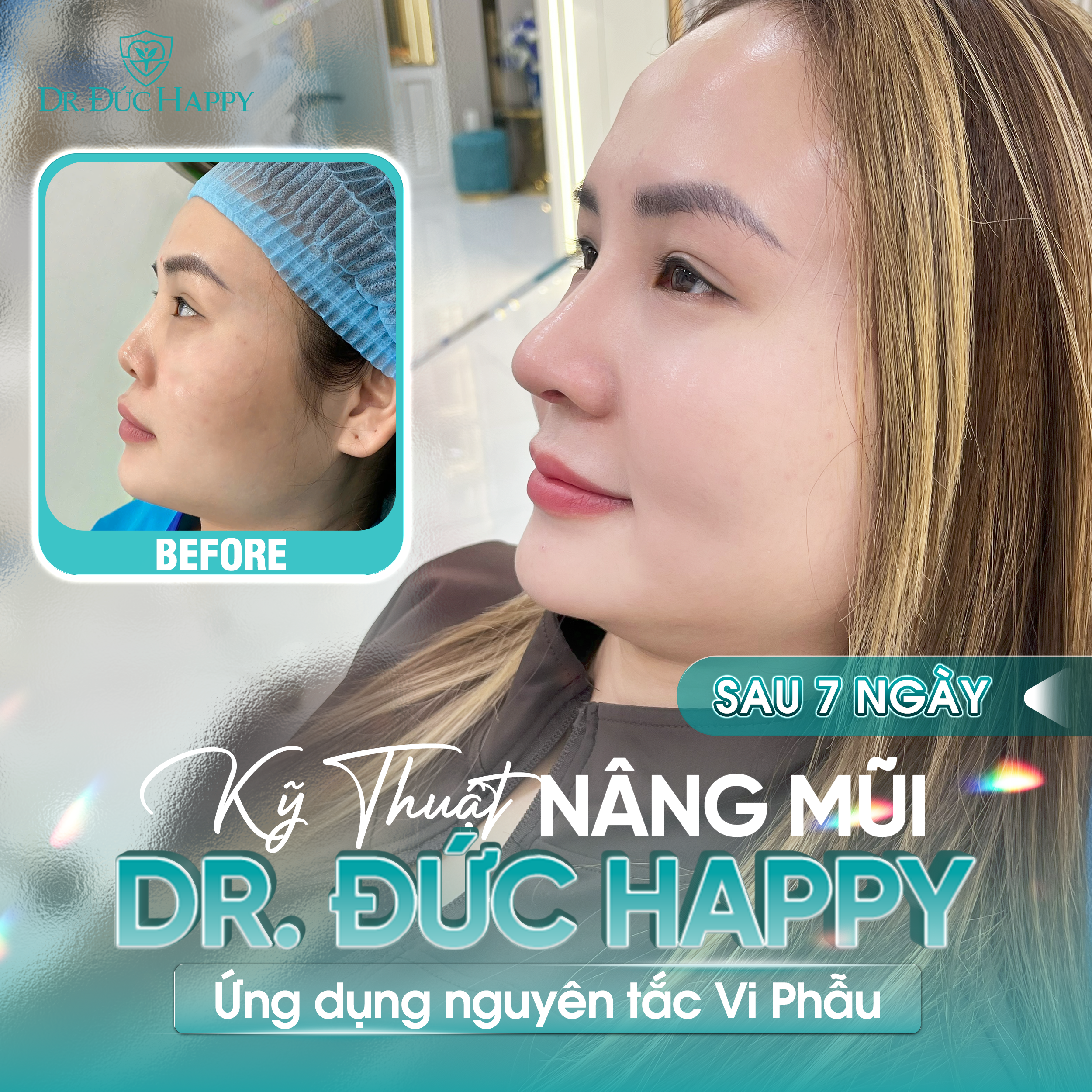 Khách hàng review nâng mũi vi phẫu tại Dr Duc Happy sau 7 ngày