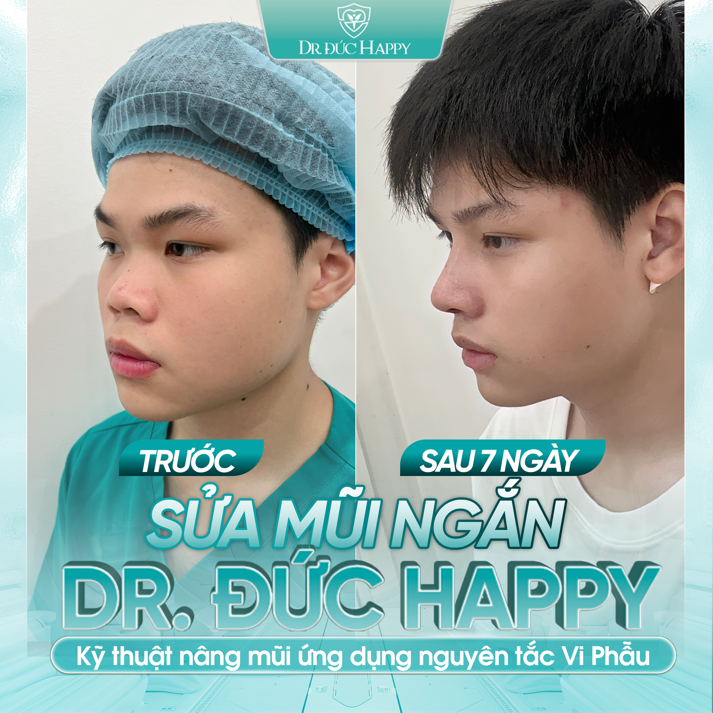 khách nam sửa mũi ngắn bằng phương pháp vi phẫu tại dr duc happy
