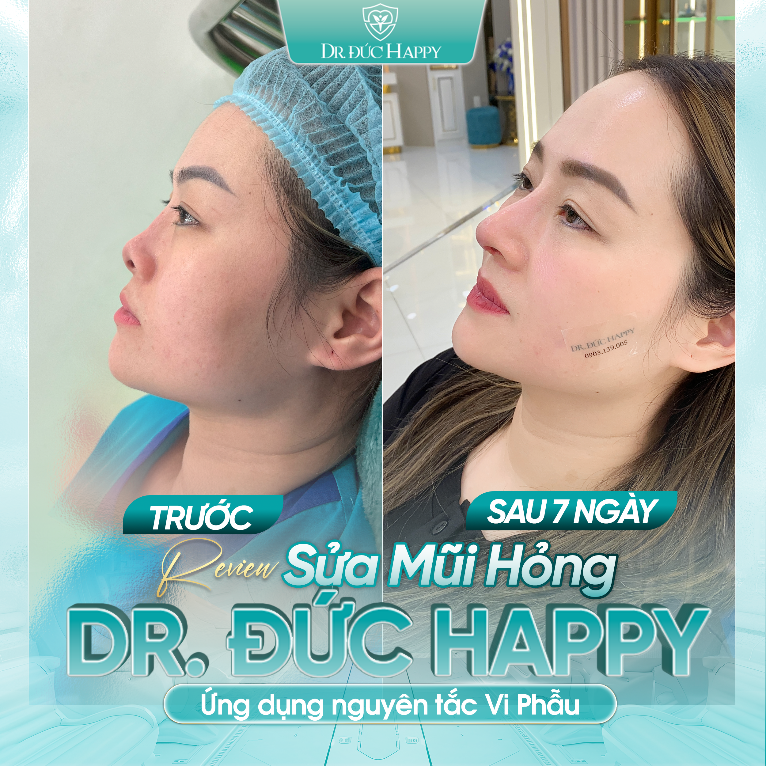 Review khách hàng sửa mũi Filler hỏng tại Dr Duc Happy