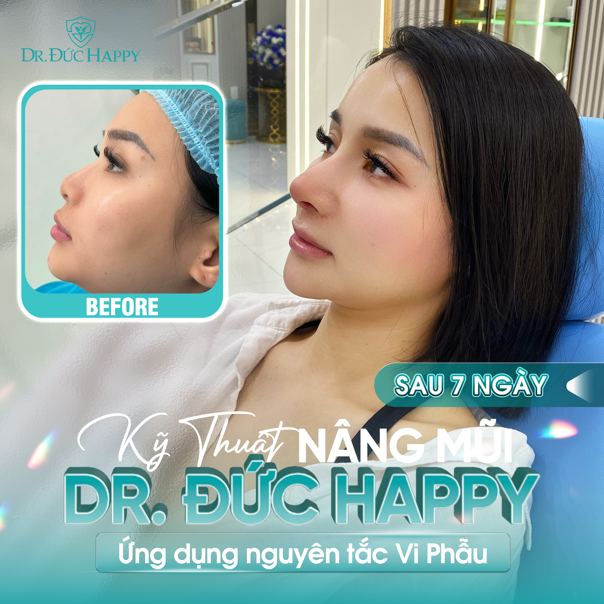 Khách nữ review nâng mũi vi phẫu tại Dr Duc Happy sau 7 ngày