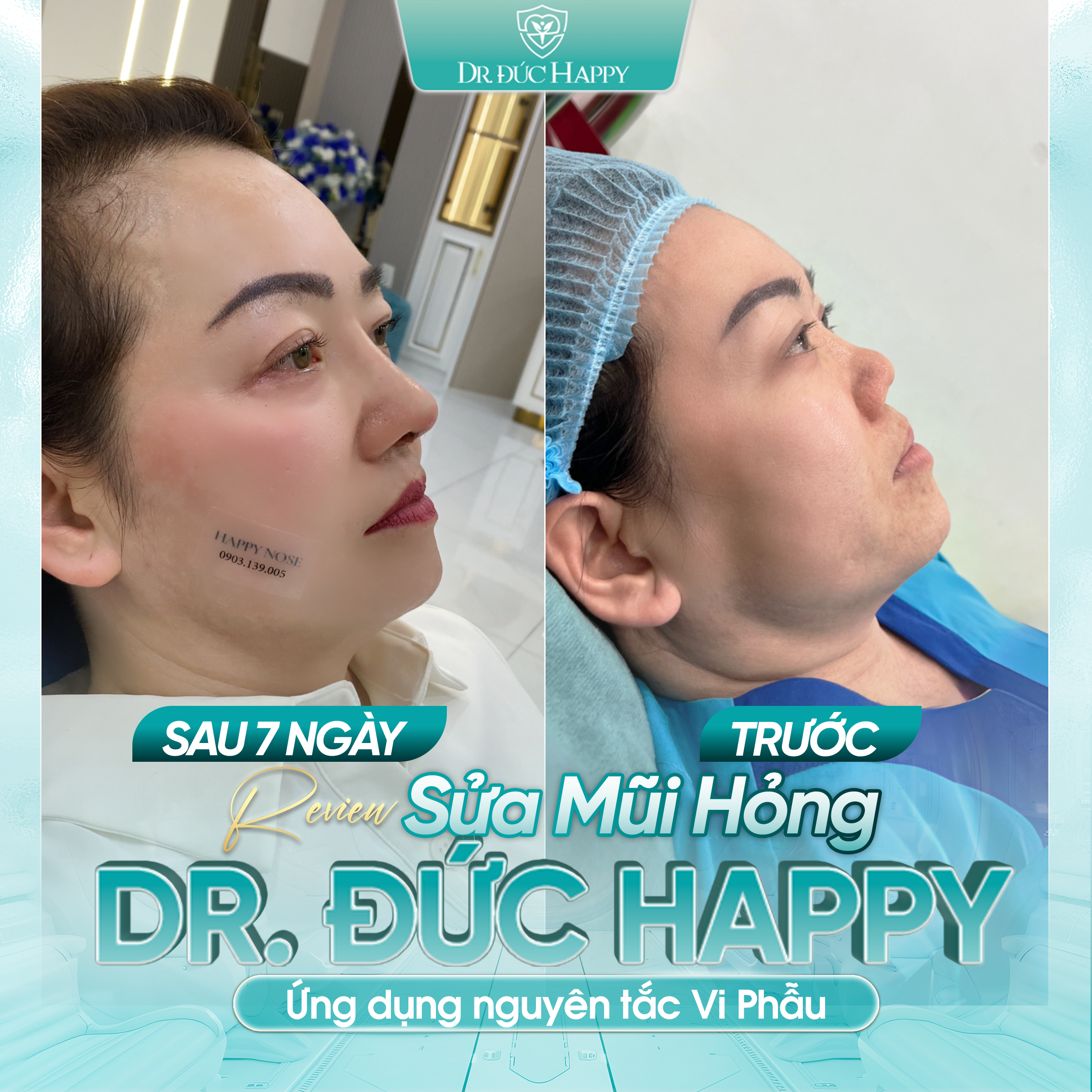 Review khách hàng sửa mũi co rút tại Dr Duc Happy