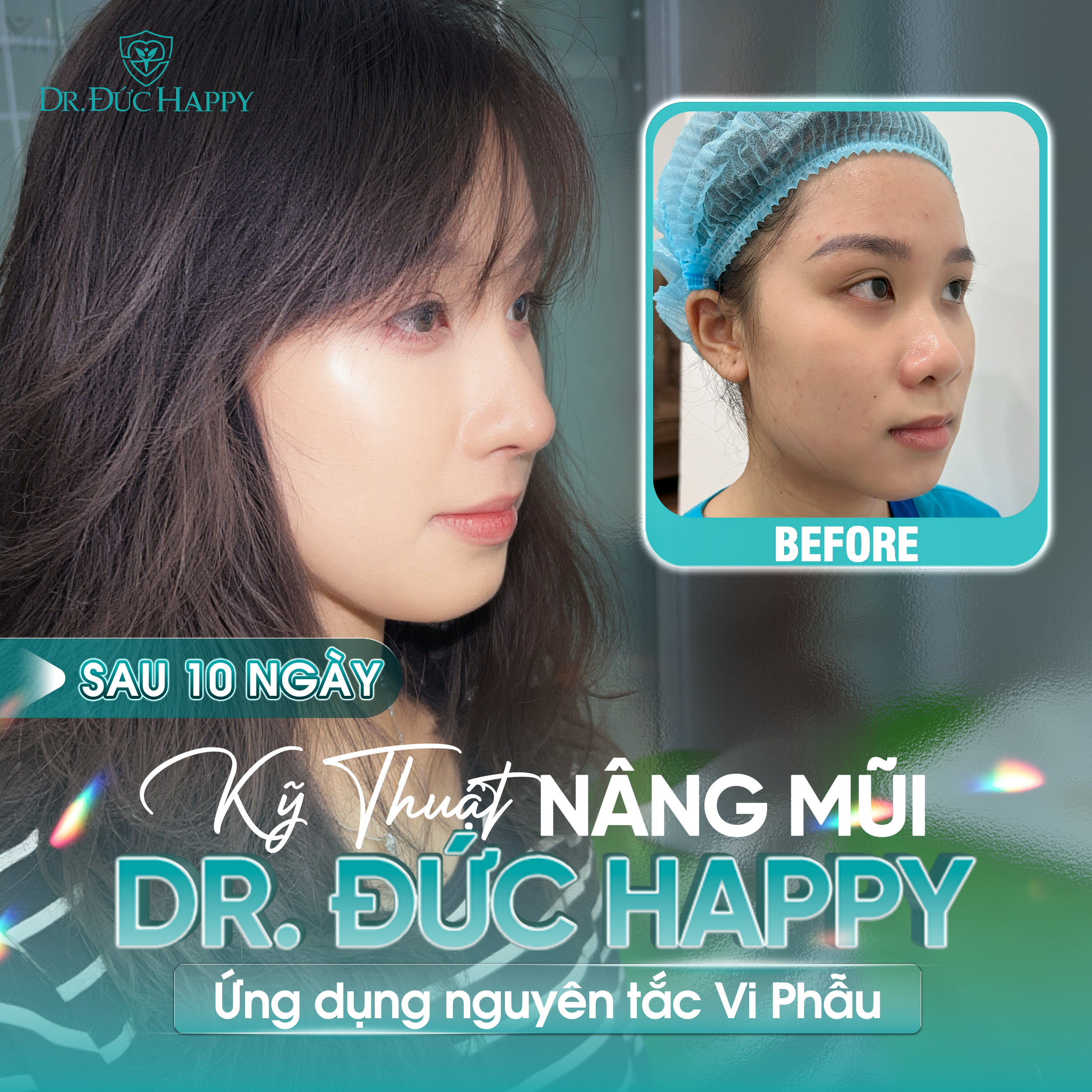 Khách hàng Genz review nâng mũi vi phẫu tại Dr Duc Happy sau 7 ngày