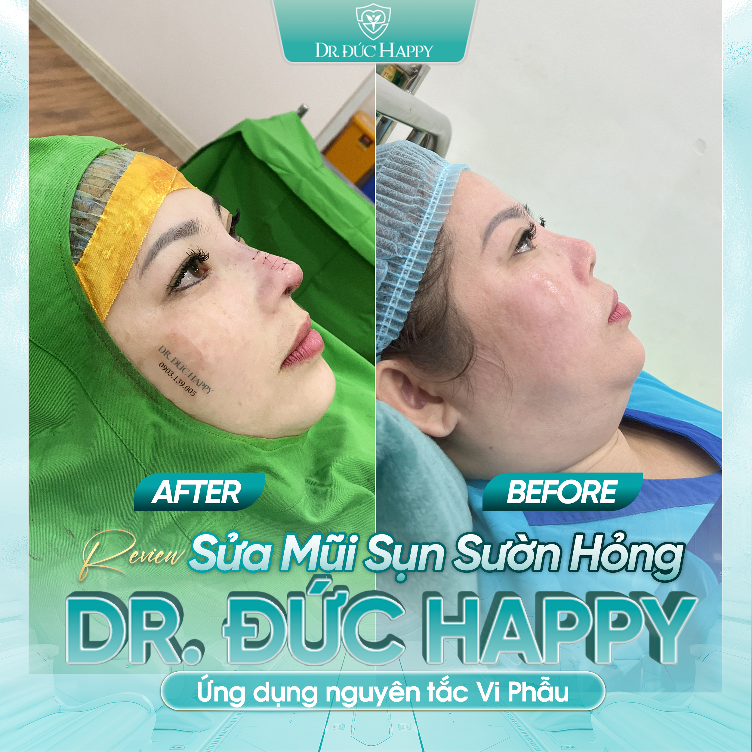 Khách hàng sửa mũi sụn sườn hỏng tại Dr Duc Happy