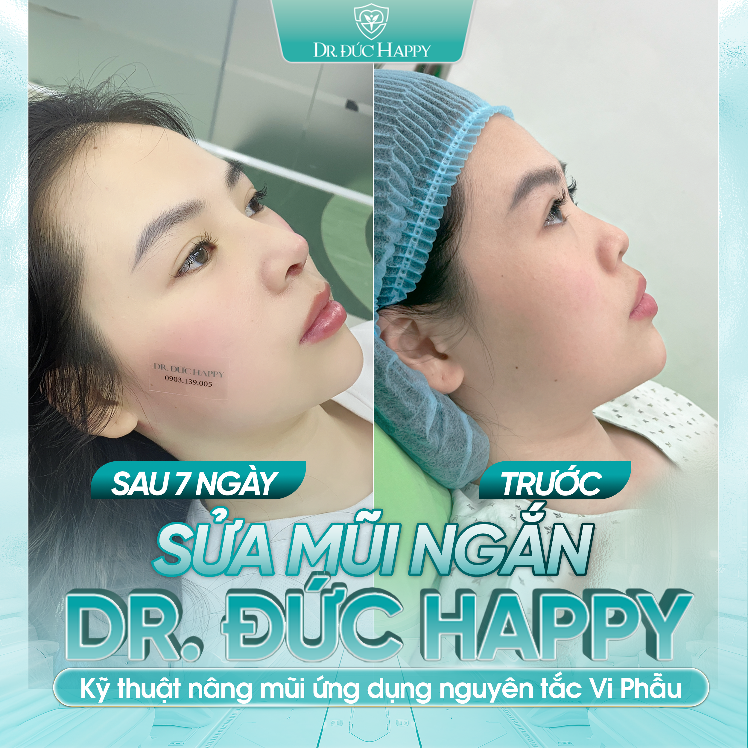 Khách hàng sửa mũi ngắn bằng phương pháp vi phẫu tại dr duc happy