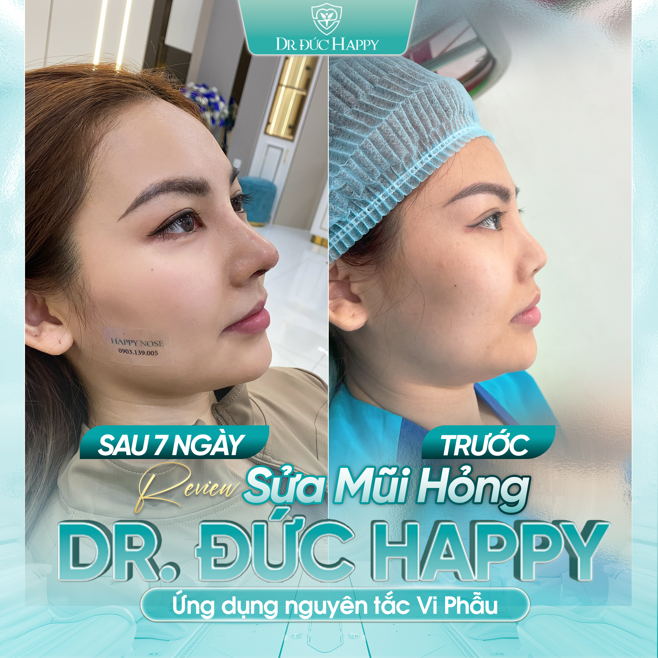 Review khách hàng sửa mũi tràn filler tại Dr Duc Happy