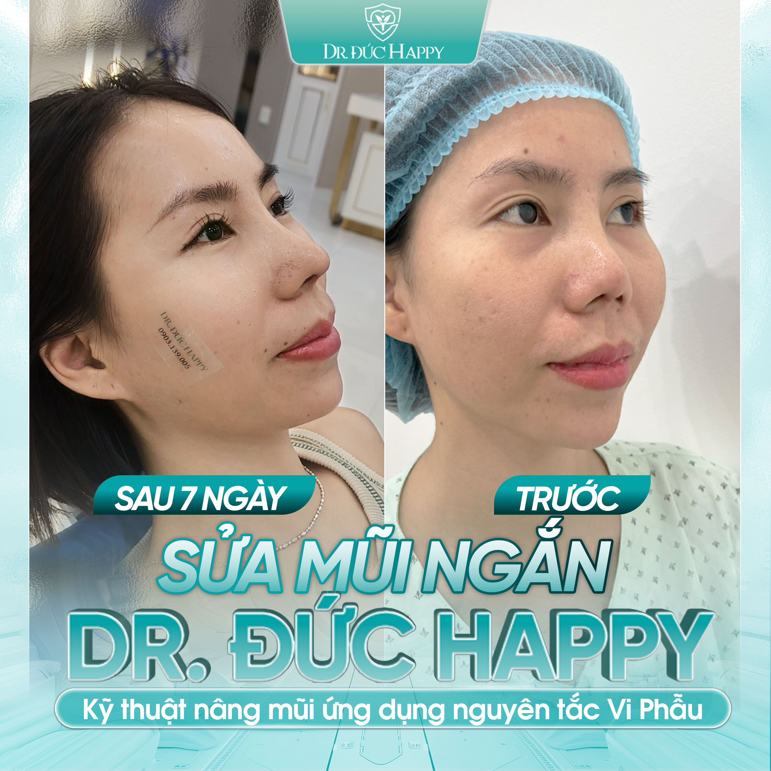 Khách hàng sửa mũi ngắn bị biến chứng nặng bằng phương pháp vi phẫu tại dr duc happy