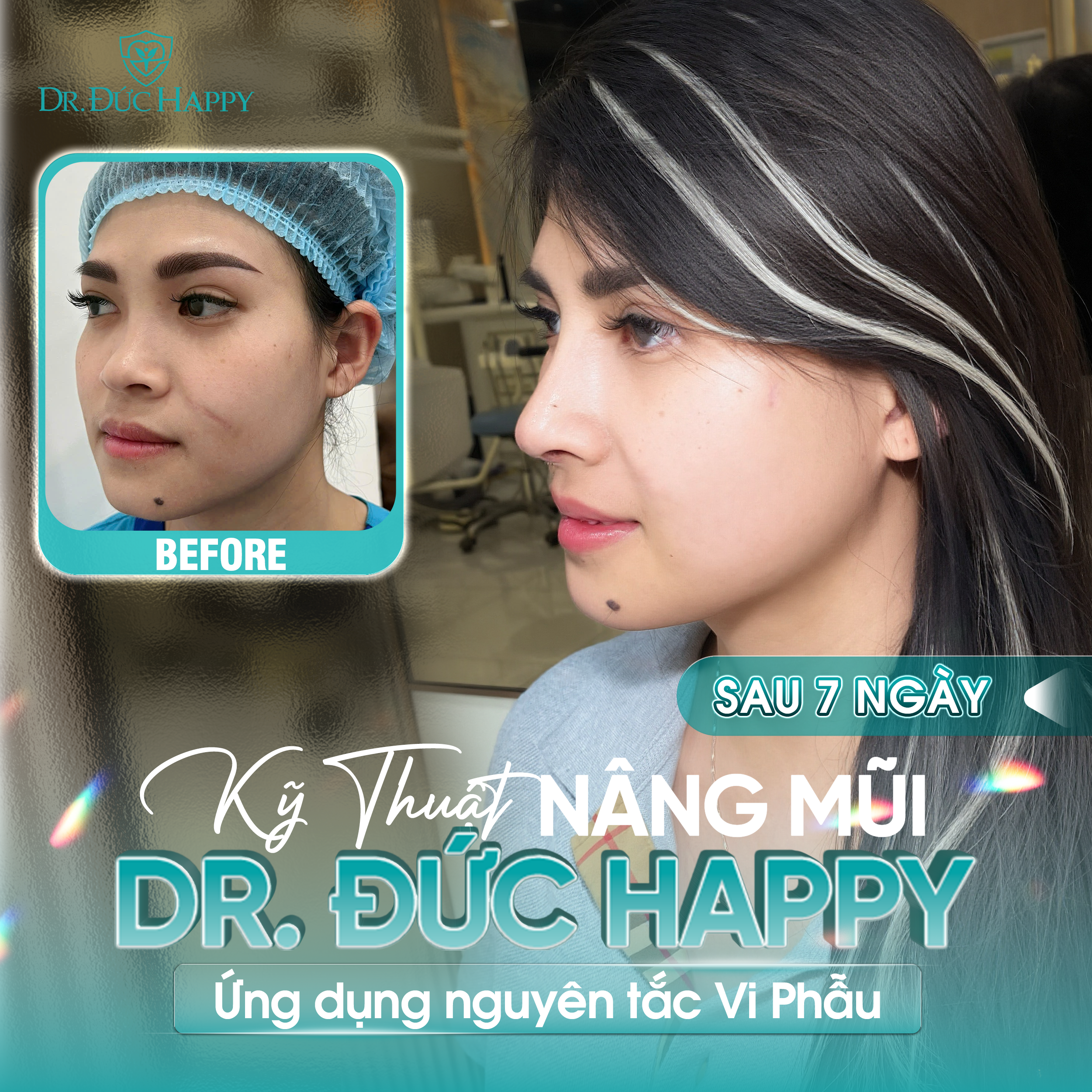 Khách hàng đến từ Mỹ review nâng mũi vi phẫu tại Dr Duc Happy sau 7 ngày