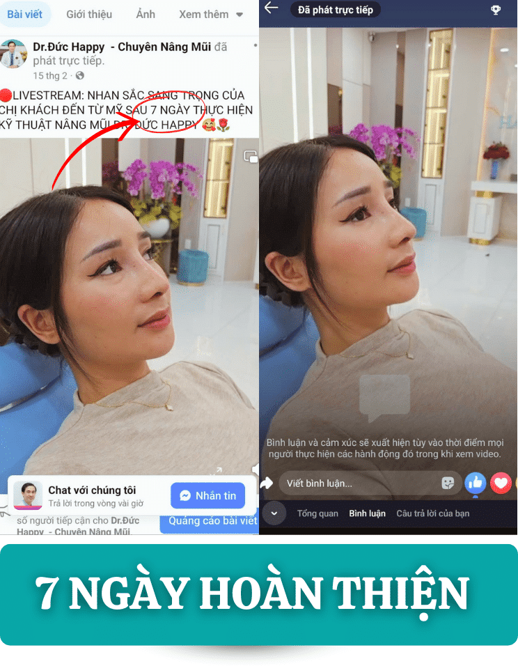 Livestream: Review nâng mũi vi phẫu 7 ngày hoàn thiện