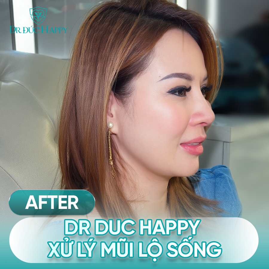 Sửa mũi lộ sóng 