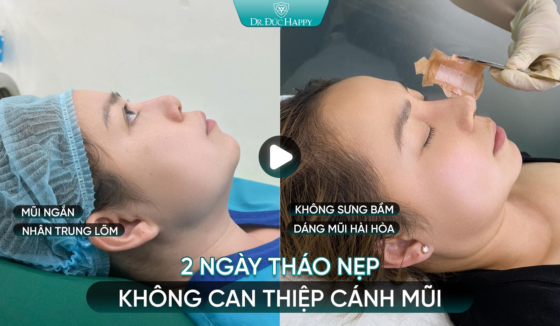 Feedback khách hàng 2 ngày tháo nẹp không can thiệp cánh mũi