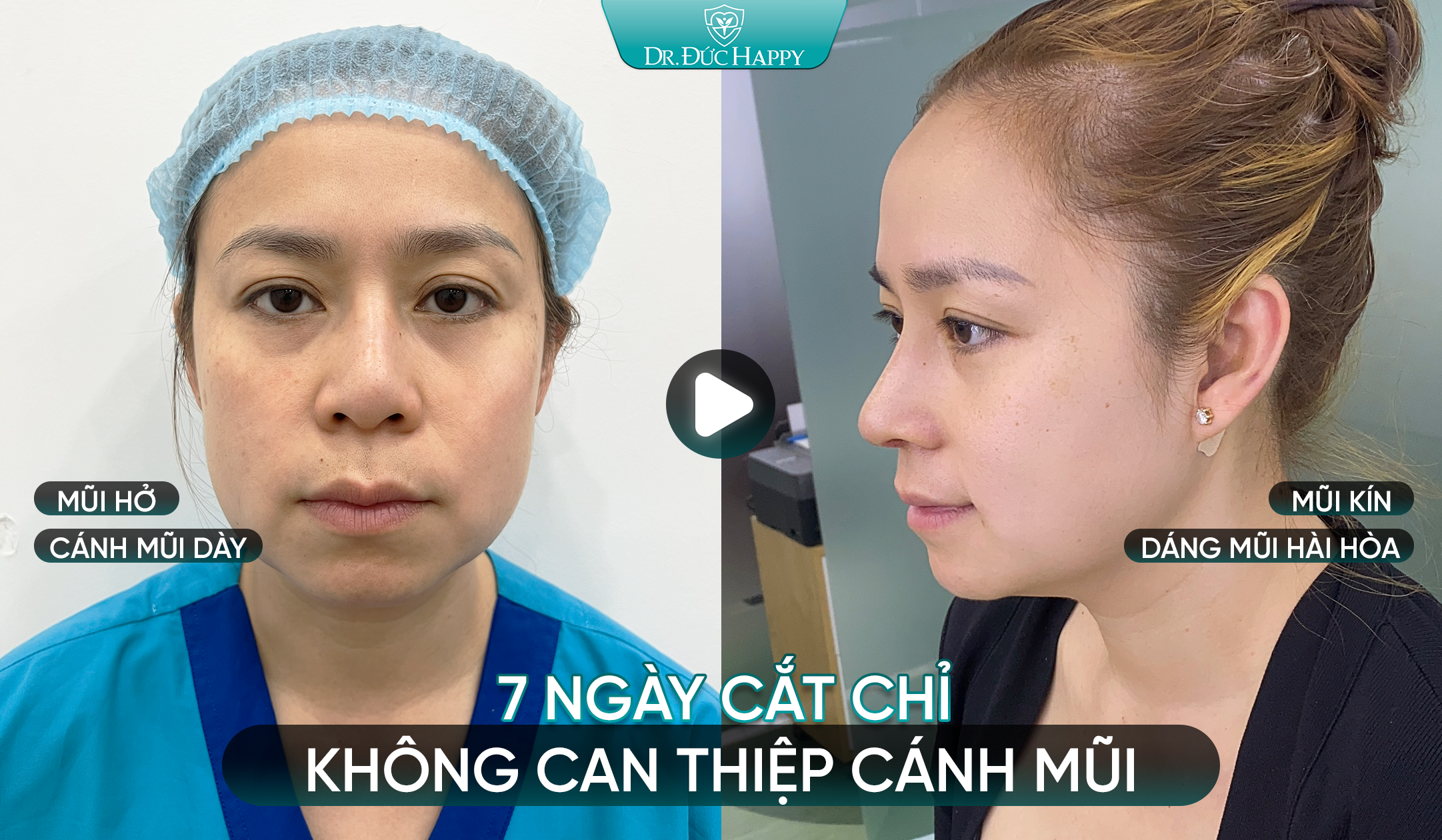 Khách hàng 7 ngày cắt chỉ không can thiệp cánh mũi