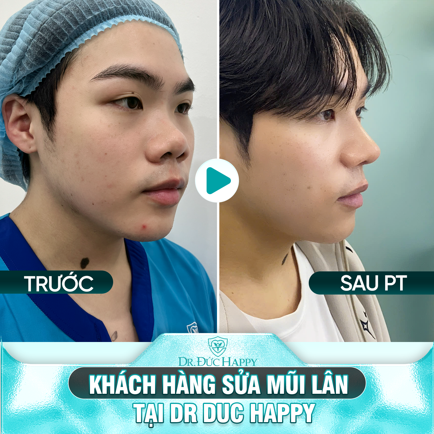 Khách hàng nam sửa mũi lân tại dr duc happy