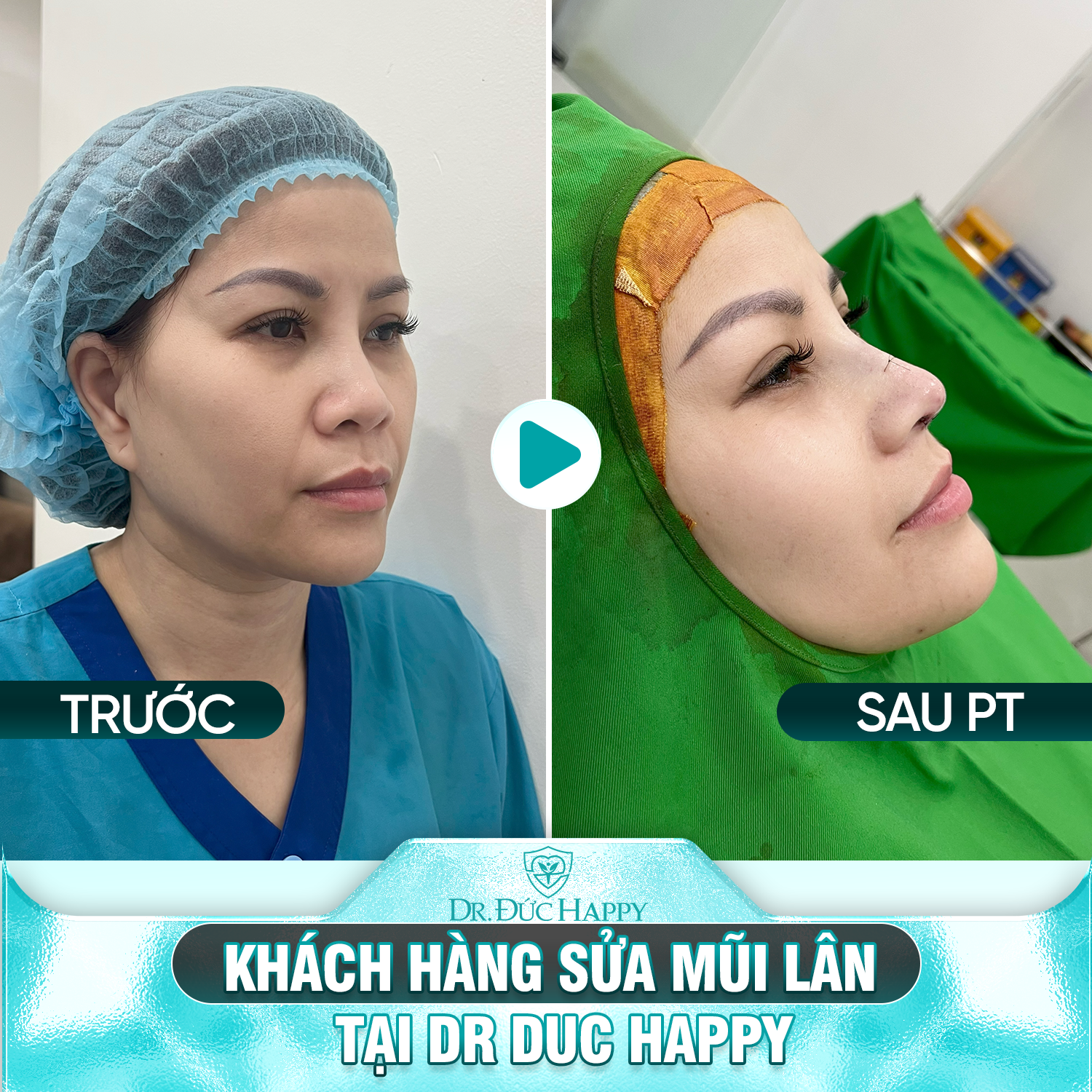 Khách hàng nâng mũi lân tại Dr Duc Happy