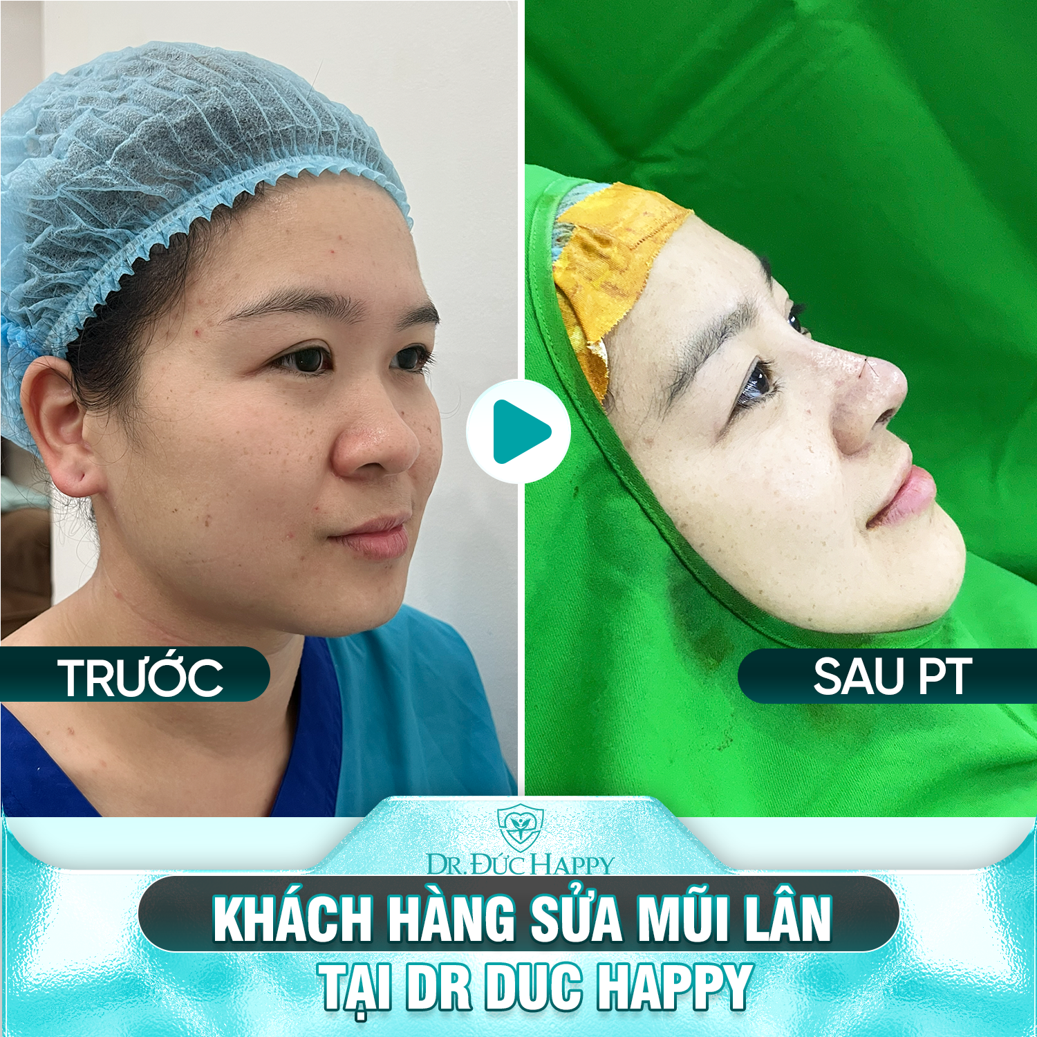 Khách hàng sửa mũi lân tại Dr Duc Happy