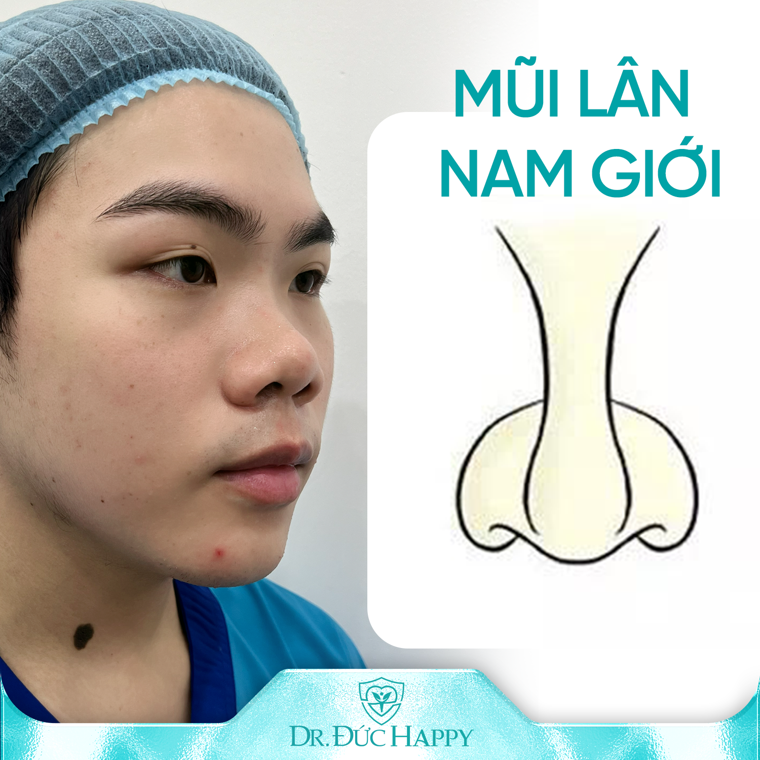 mũi lân tốt hay xấu ở nam giới