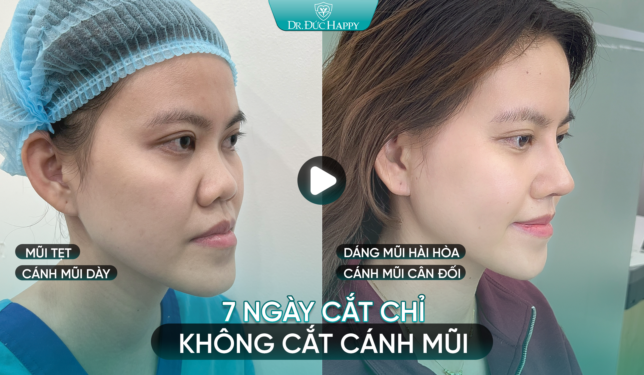 Khách hàng nâng mũi 7 ngày cắt chỉ không cắt cánh mũi