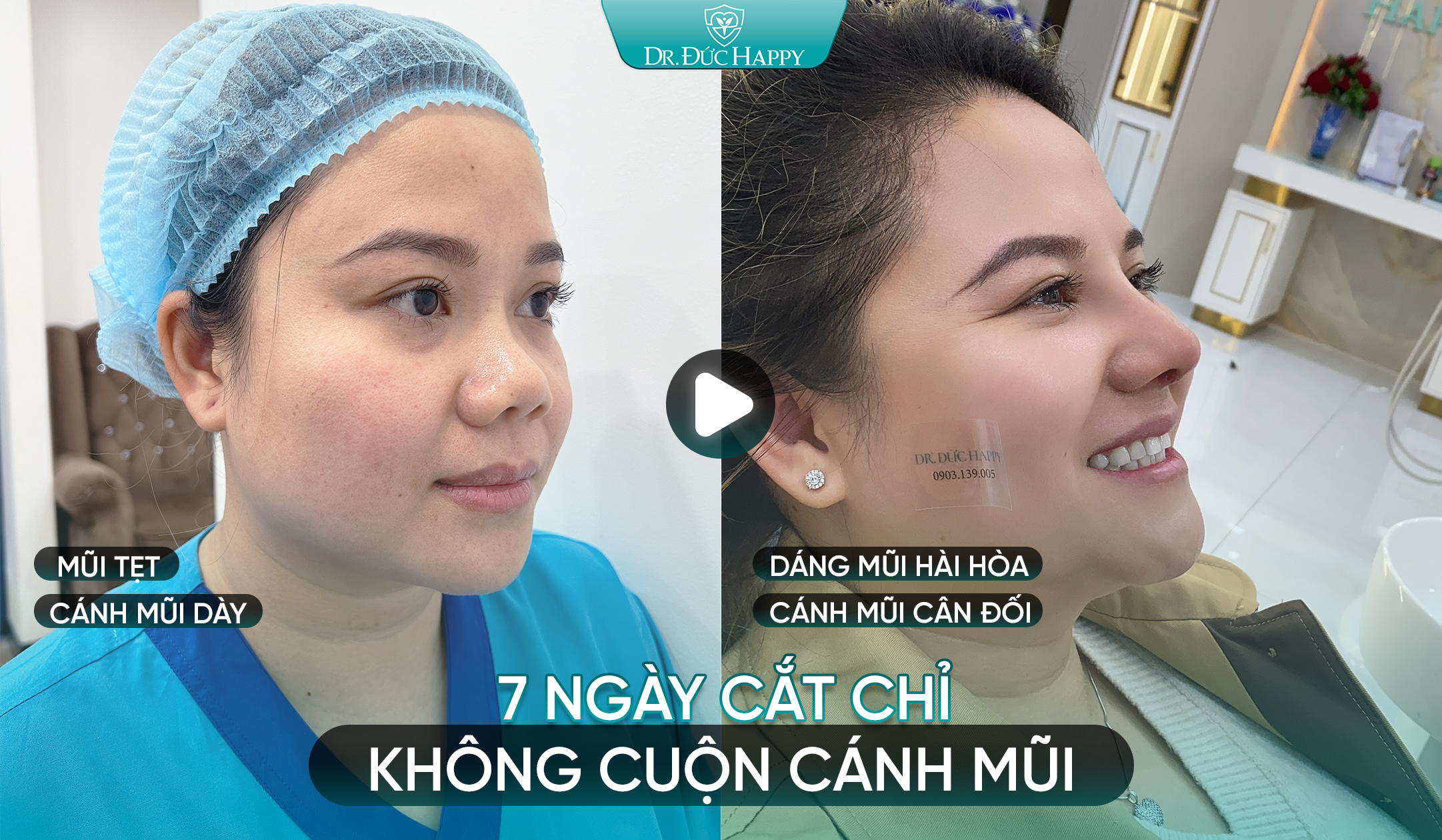 Khách hàng nâng mũi 7 ngày cắt chỉ không cuộn cánh mũi