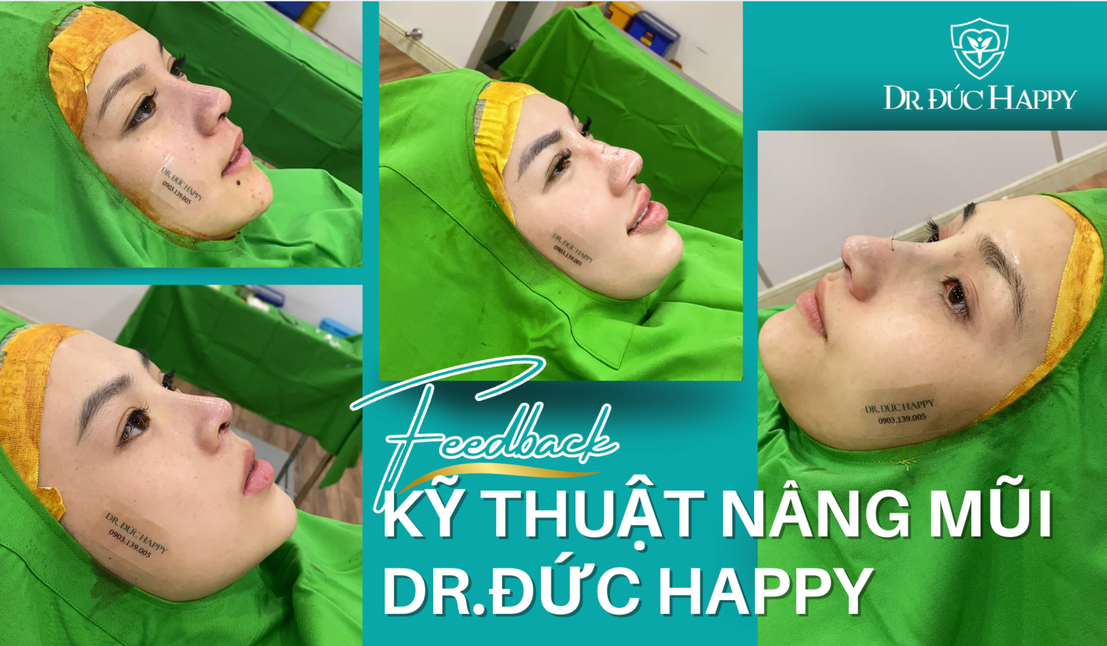 nâng mũi vi phẫu có sưng bầm không?