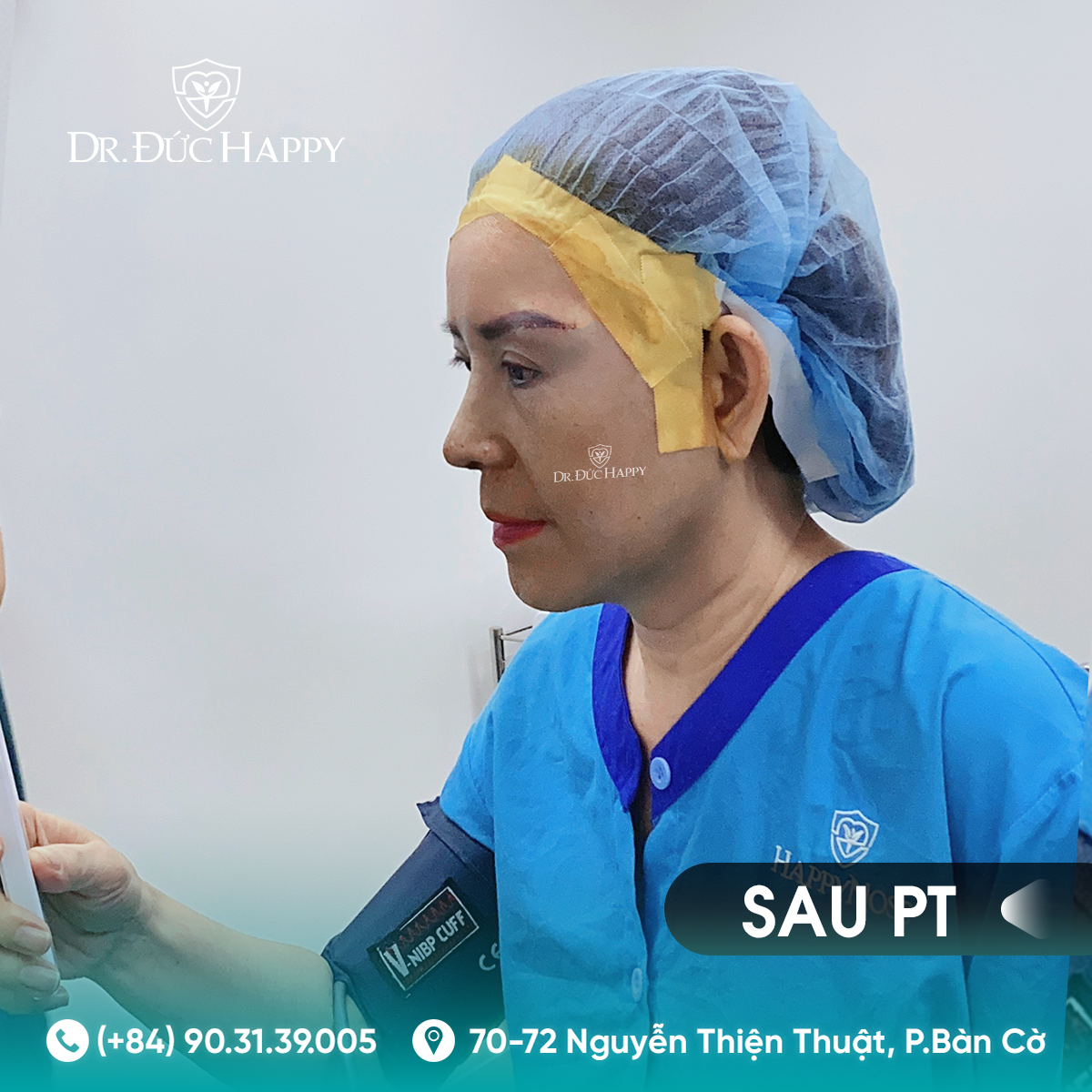 Xem kết quả dáng mũi sau khi thực hiện Kỹ thuật nâng mũi Dr. Đức Happy