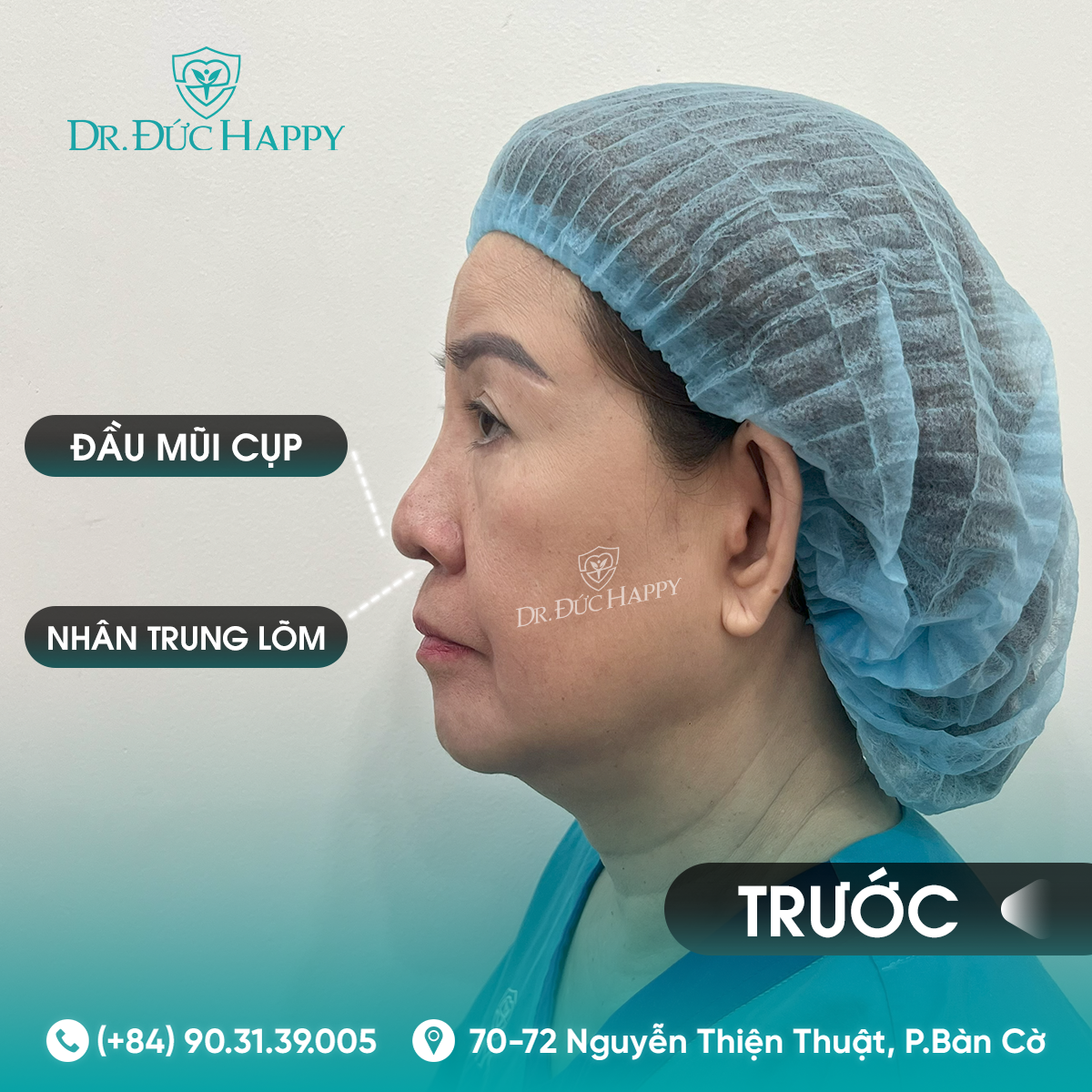 Biến chứng sau nâng mũi khi đặt niềm tin sai nơi và sai kỹ thuật