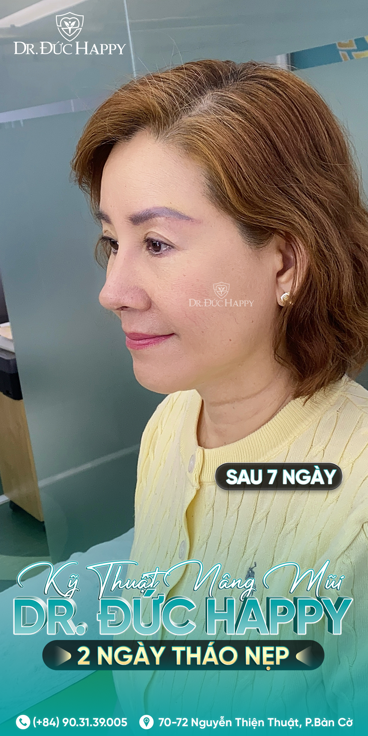 Kỹ thuật nâng mũi Dr. Đức Happy, ứng dụng vi phẫu, 7 ngày cắt chỉ
