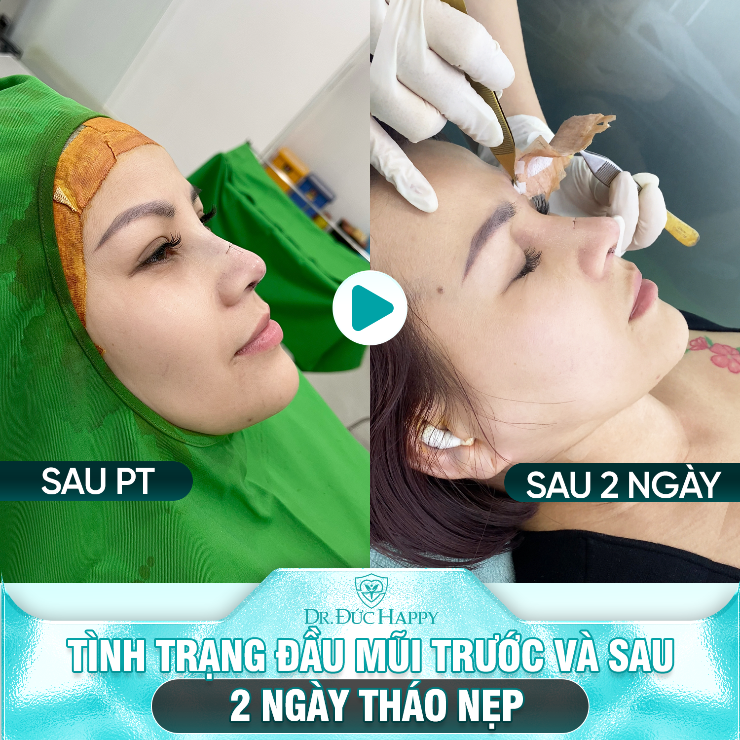 Tình trạng đầu mũi trước và sau 2 ngày tháo nẹp tại Dr Duc Happy